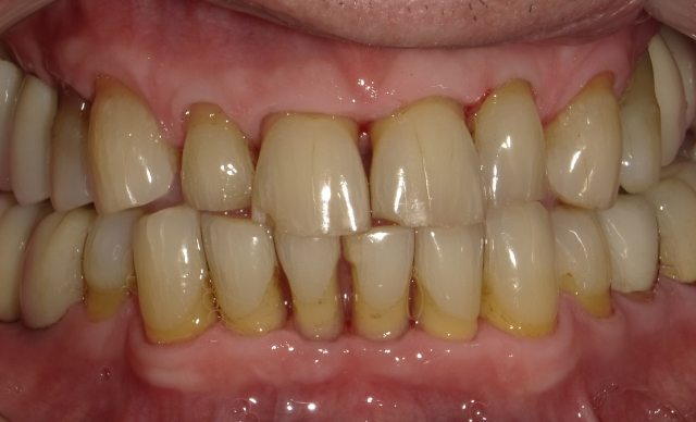 Guided Biofilm Therapy (GBT) after