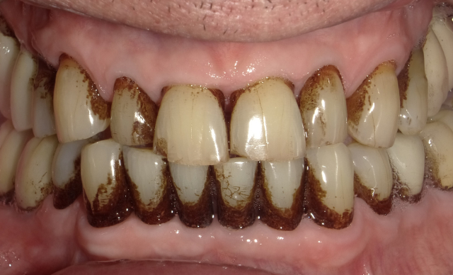 Guided Biofilm Therapy (GBT) before