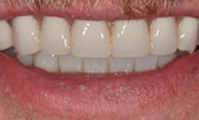 Implant Smile Makeover after