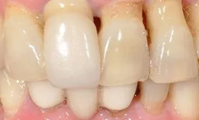 Implant-Supported Restoration before