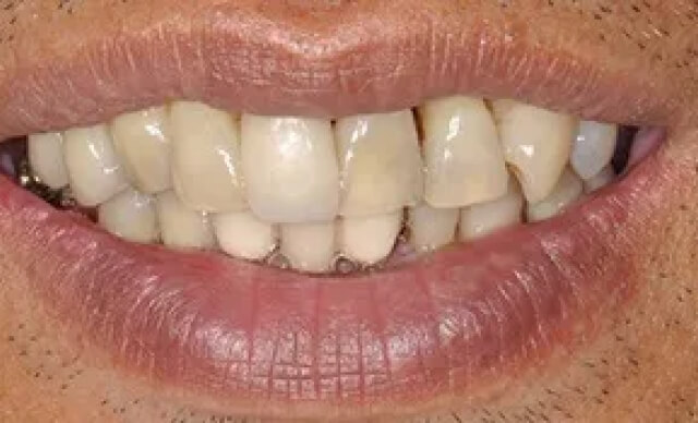 Complete Smile Renewal before
