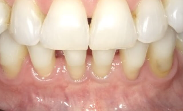 Pinhole® Gum Rejuvenation before