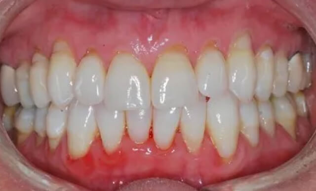 Pinhole® Gum Rejuvenation before