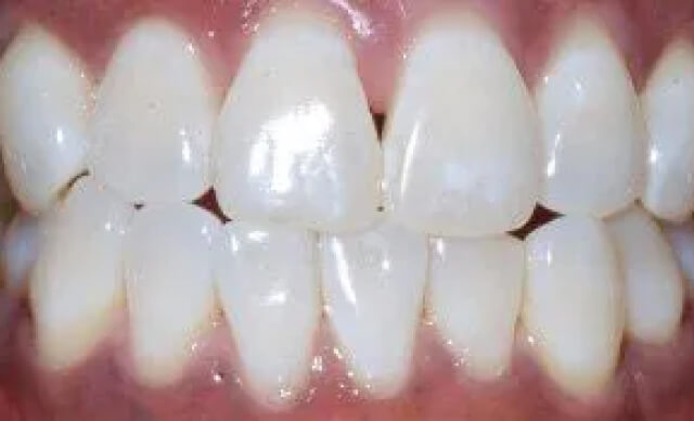 Pinhole® Gum Rejuvenation before