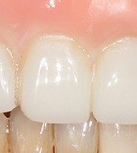 Patient after dental implant restoration