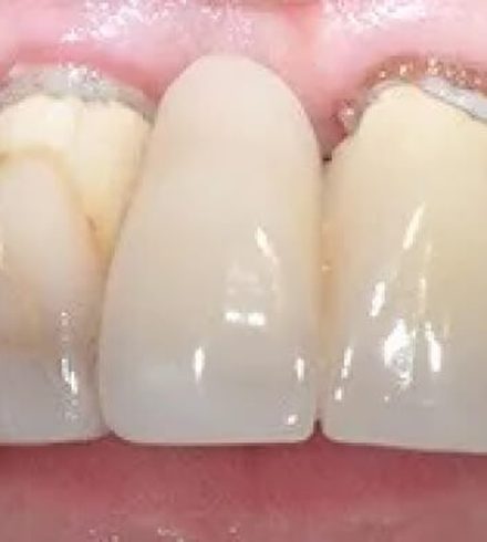 Patient before dental implant restoration