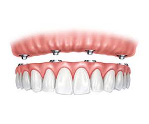 All-on-4 dental implants are implant-supported dentures available in Suffolk County, Long Island NY.