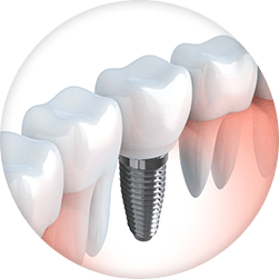 Long Island's most advanced dental implants.