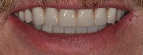After Full Mouth Restoration (Facial)