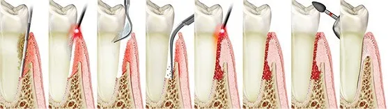 The LAPIP protocol for peri-implantitis