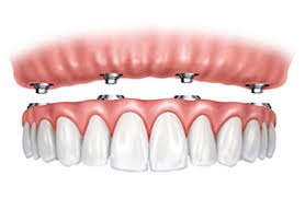 All-on-4 dental implants are a great alternative to dentures.