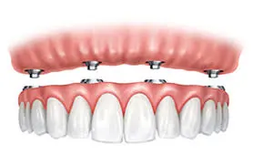 All on 4 dental implants Long Island NY. A detailed illustration of how patients in Long Island All on four dental implants are installed.