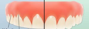 Bruxisim, or tooth grinding, is damaging to teeth.