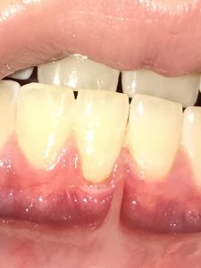Gum disease can be helped with LANAP laser gum surgery in Long Island