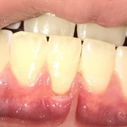 Gum disease can be helped with LANAP laser gum surgery in Long Island