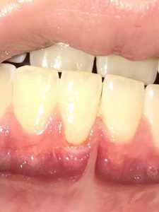 Periodontists in Long Island that treat gum disease and bone loss. Dentists in Hauppauge and Medford NY