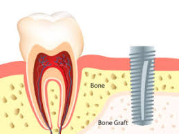Bone grafting is part of treatment for tooth loss
