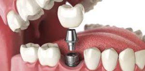 Saving dental implants with laser gum surgery.
