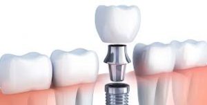 Dental implants are a permanent restoration for lost teeth.