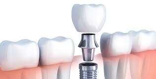 Laser gum surgery can save infected dental implants.