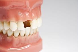 Dental implants replace missing teeth. Long Island dental implants near me. 