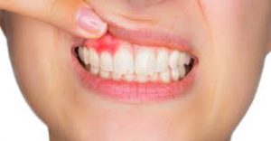 Periodontal disease warning signs include inflamed and receding gums