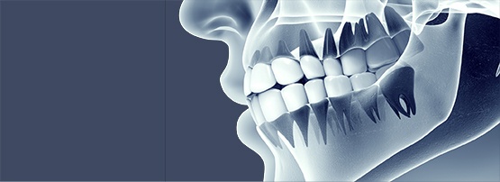Long Island oral surgeons for tooth Removal and Socket Grafting in with dentist offices in Hauppauge and Medford NY. Long Island oral surgery.