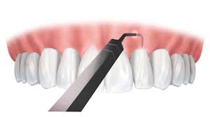 The pinhole surgical technique is a recent development in gum surgery.