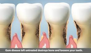 Psoriasis and gum disease can be cured with laser gum surgery that removes most of the bacteria associated with bone loss.