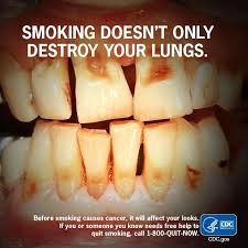 Smoking can highly increase chance of tooth loss.