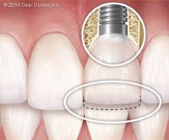 The best dental implants Long island has available begin with temporary restorations.