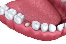 Tooth loss is more common among the elderly.