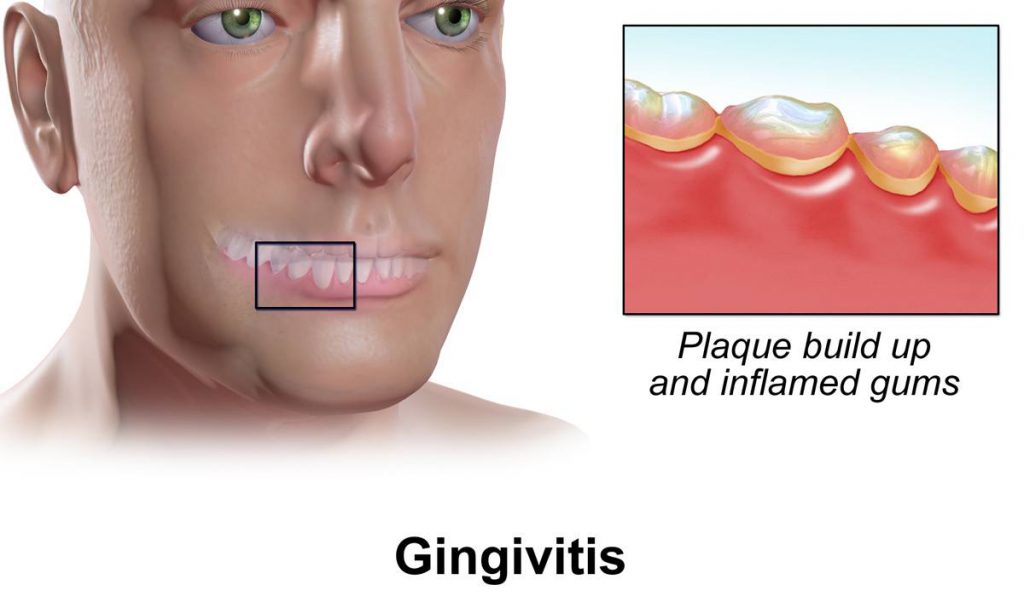 Gingivitis is a common kind of periodontal disease. Symptoms of gingivitis disease include puffy and red gums, that can bleed easily when brushing teeth.