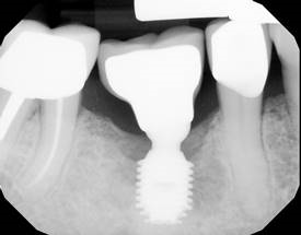 One year after LAPIP treatment.