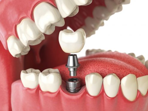 Here is how dental implants replace missing teeth.