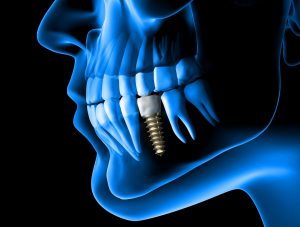 Dental implants provided by Farber Center on Long island