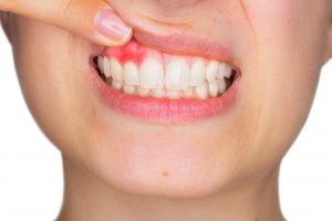 Gum disease treatment at Farber Center.