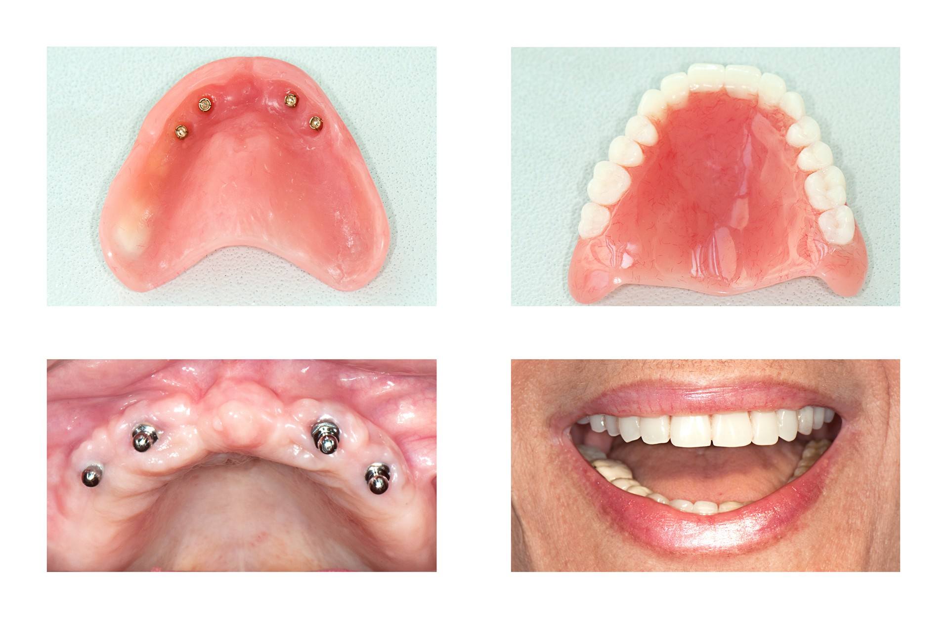 Dental implants hold permanent dentures in place.