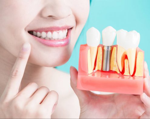 Dental implants replace lost teeth and can help with holistic and overall body health