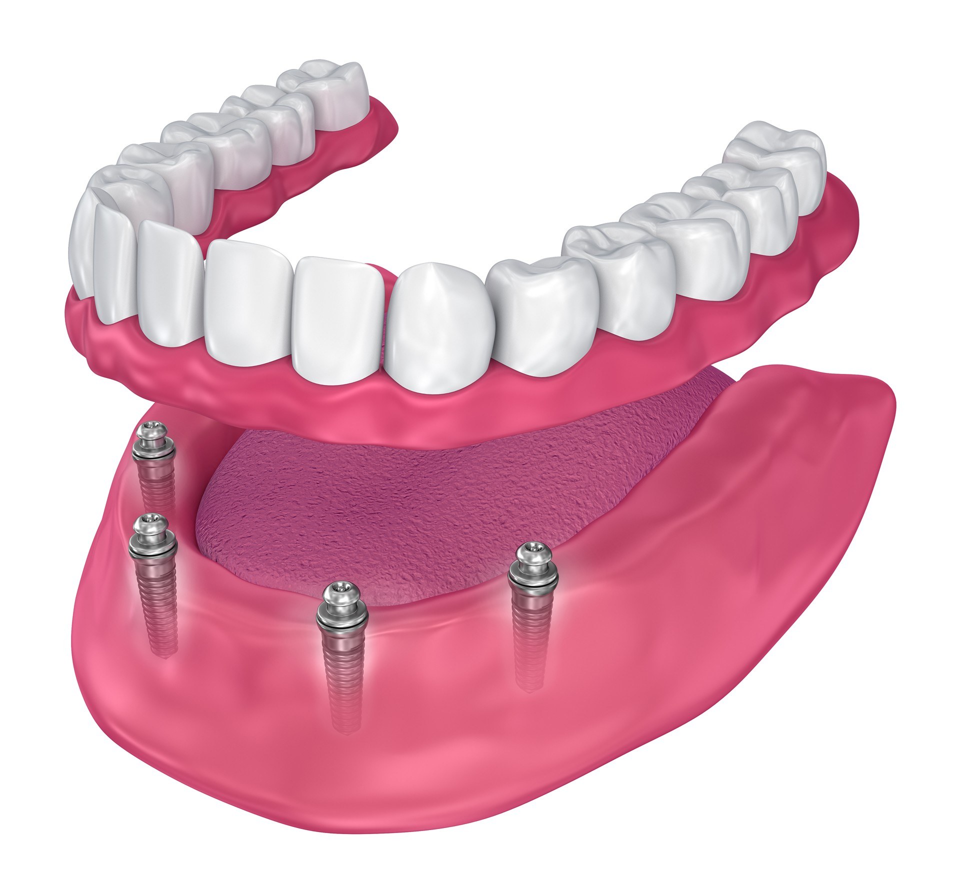 Illustration of permanent dentures. Long Island dental clinic with full mouth dental implants to replace dentures permanently.
