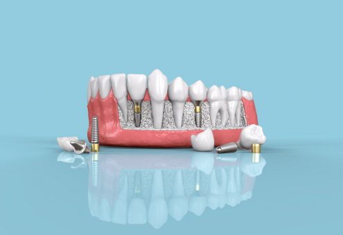 Best Long Island dental implants in Suffolk County NY and Nassau County NY in Hauppauge and Medford NY