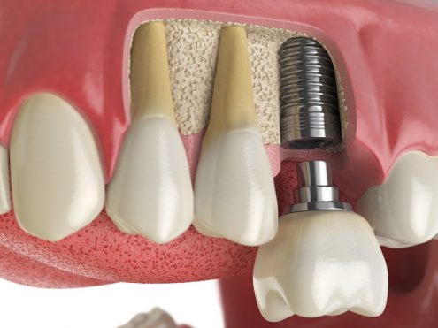 Dental implants replace teeth and maintain a strong bite.