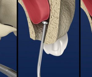 Sinus lift surgery at Farber Center Long Island sinus augmentation for dental implants Nassau County.