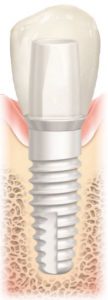 Ceramic dental implant with a tooth-colored crown, illustrating biocompatible material for holistic dentistry and aesthetic advantages in dental procedures.