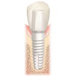 Long Island dental implants made with ceramic instead of metal, available at the Farber Center in Medford NY and Hauppauge NY