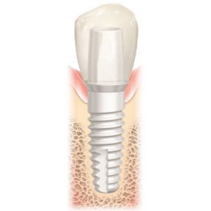 Metal free dental implants also contain require no adhesives.