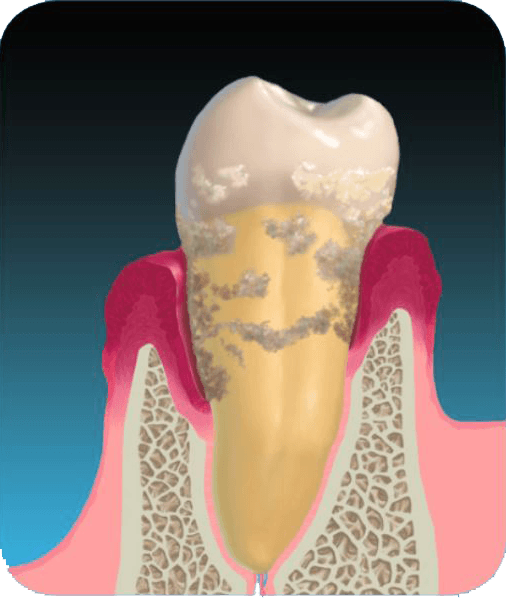 Recent advances in holistic non-surgical periodontal treatment includes Perioscopy.