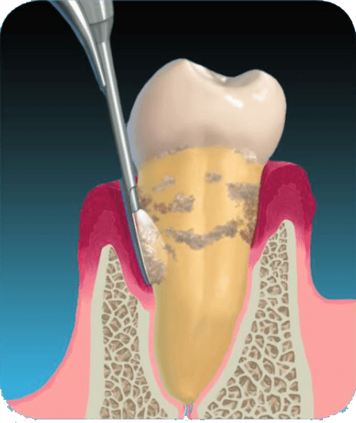 Perioscopy is an alternative to oral surgery that can improve gum health.