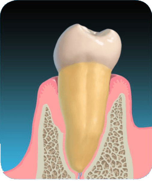 Perioscopy is now available as a non-surgical holistic periodontal treatment in Long Island.