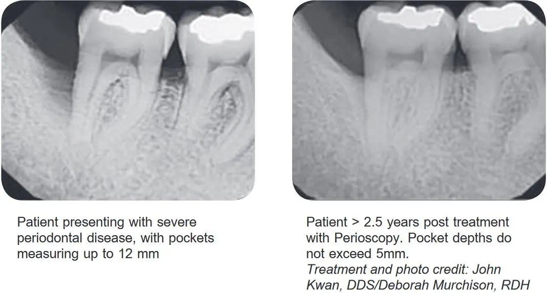 Before and after non-surgical periodontal treatment in Long Island